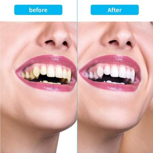Ultrasonic Tooth Cleaner Tartar Remover - 5-Speed Rechargeable Dental Care image