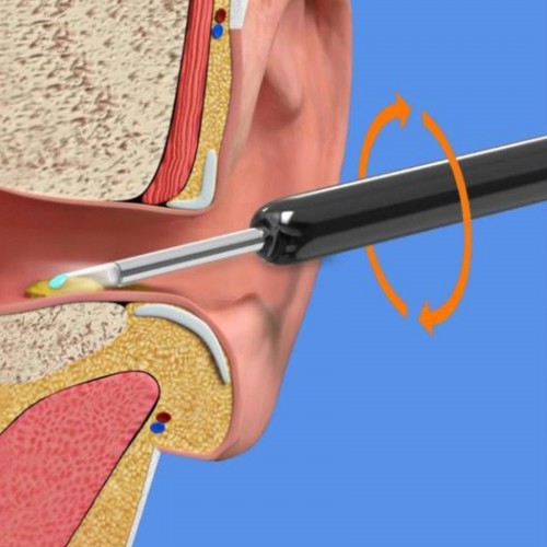 NE3pro Otoscope - 1080P HD Video, Elimination Spoon, High-Resolution Load Otoscope. image